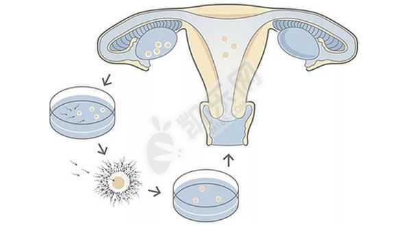 广西供卵机构是真的吗，做试管婴儿的精子是如何挑选出来的？